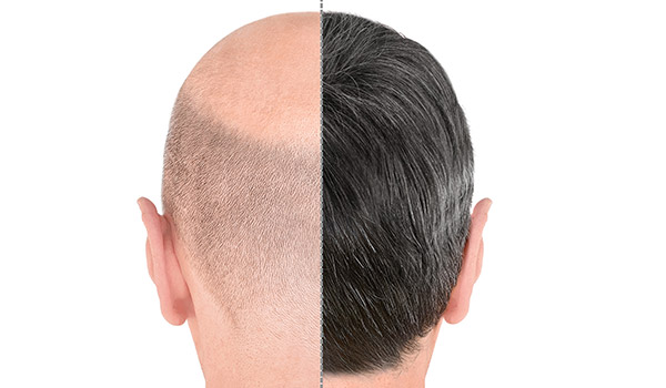 Hair Replacement in Bangalore